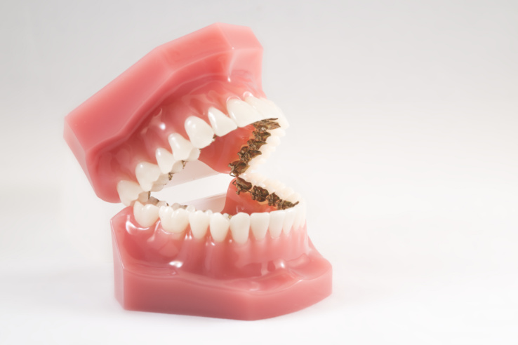 Ortodoncias lingual